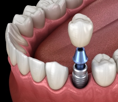 Animated dental implant supported dental crown placement