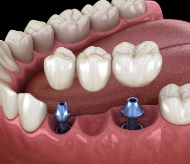 Animated dental implant supported fixed bridge placement