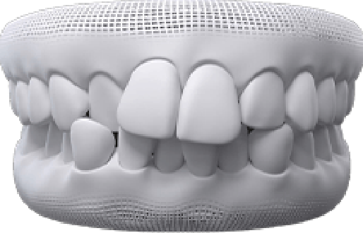 Animated dental implant supported dental crown placement