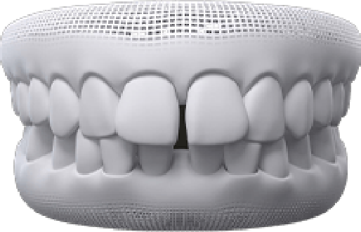 Animated dental implant supported fixed bridge placement