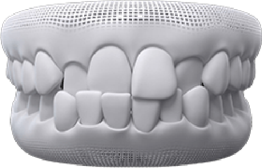 Animated dental implant supported denture placement