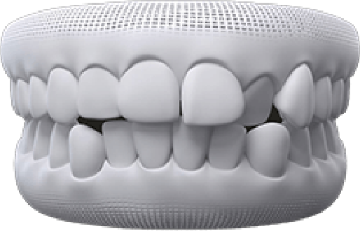 Animated dental implant supported denture placement