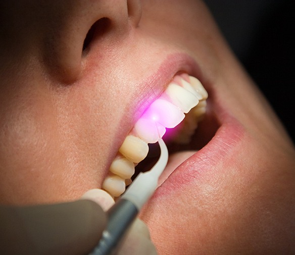 Patient receiving laser periodontal therapy