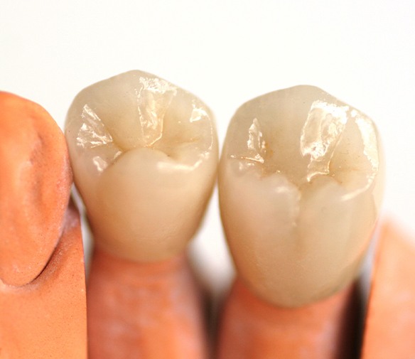 Model smile with dental crown restoration