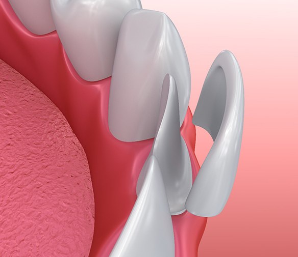 Illustration of veneer being placed on tooth